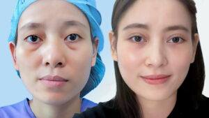 Cắt mí mắt dưới: Công dụng, rủi ro và thời gian hồi phục