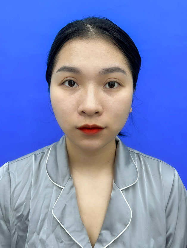 Cắt mí hỏng, lệch hai bên không cân đối