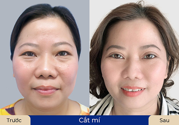 Cắt mí cho người trung niên thường có kỹ thuật phức tạp hơn để tạo ra nếp mí tự nhiên