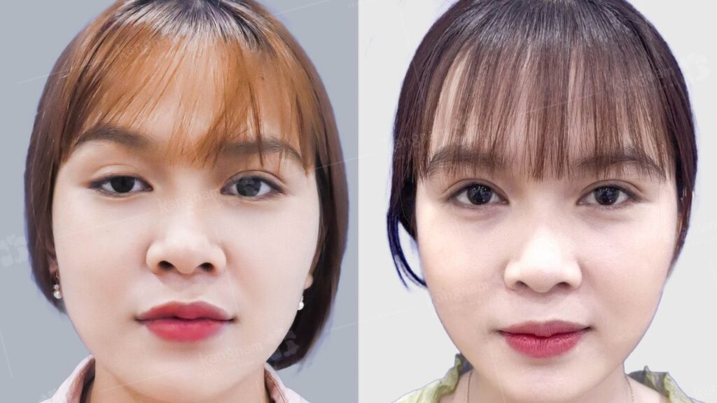 Cắt mí mắt ở đâu đẹp tại Hà Nội? Gợi ý 5 địa chỉ uy tín