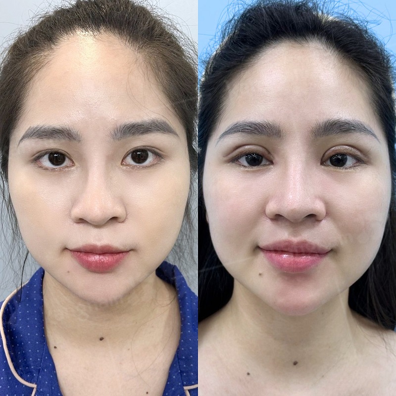 Lựa chọn địa chỉ cắt mí uy tín giúp khách hàng sở hữu nếp mí cân đối