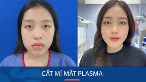 Cắt mí mắt Plasma là gì? Cơ chế, ưu điểm và những điều cần biết