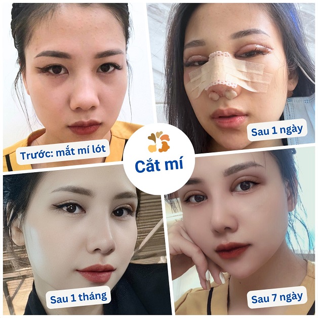 Mí mắt sau khi cắt 1 tháng: Không lộ rõ sẹo xấu