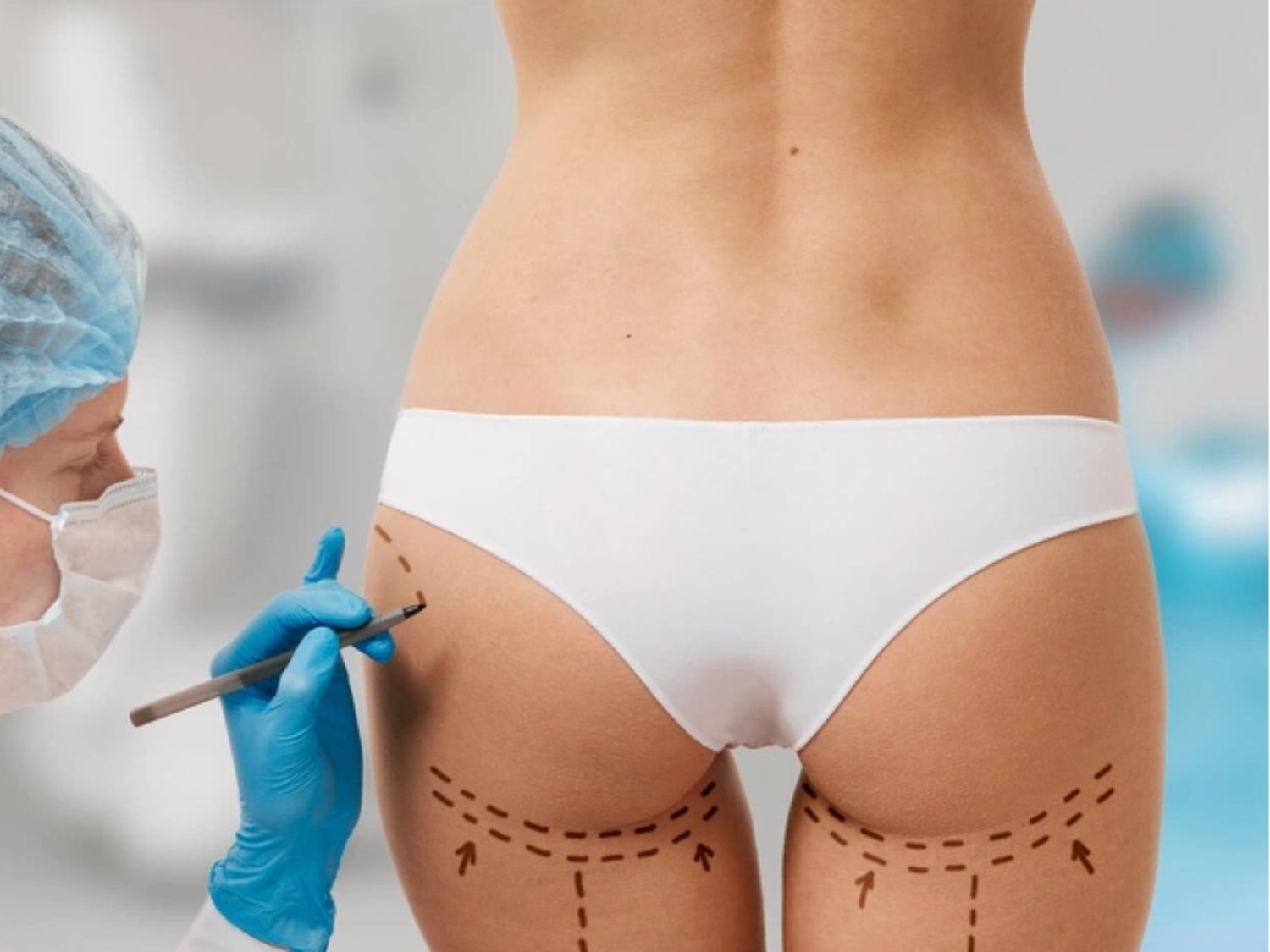 Phương pháp làm đẹp cấy mỡ hông (1) đang được rất nhiều tín đồ yêu thích