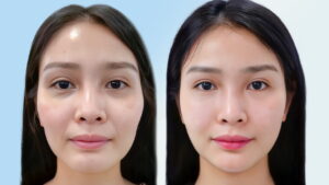 Cấy mỡ mặt – Sự lựa chọn hoàn hảo cho làn da xinh đẹp