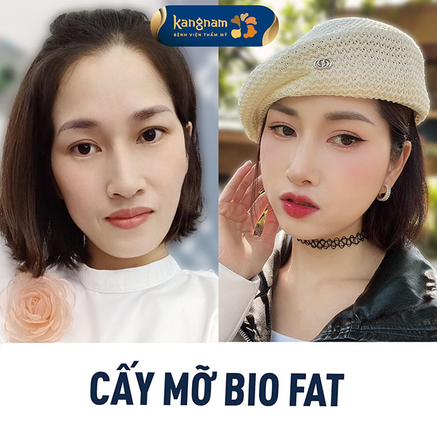 Mỡ sau khi cấy lên mặt theo thời gian sẽ tương thích hoàn toàn vào da