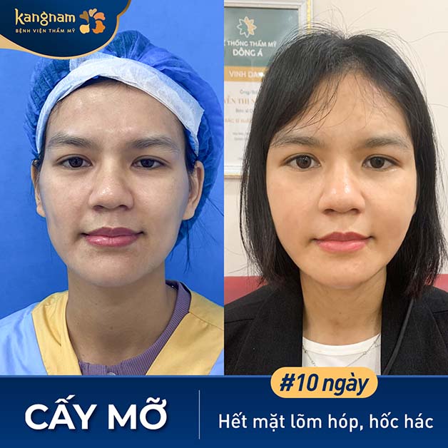 Phương pháp cấy mỡ mặt đang trở thành lựa chọn phổ biến nhất hiện nay