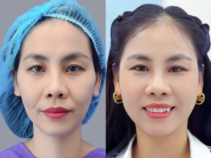 Cấy mỡ mặt giúp da mịn màng, tươi trẻ