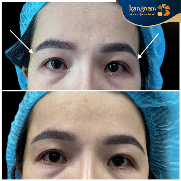 Người có khuyết điểm như mặt gầy, mặt hóp, thiếu cân đối