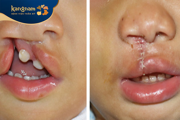 Kinh nghiệm chăm sóc sau phẫu thuật