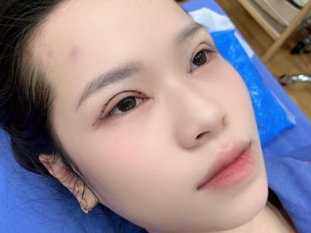Mắt còn sưng và chưa vào nếp mí sau khi cắt