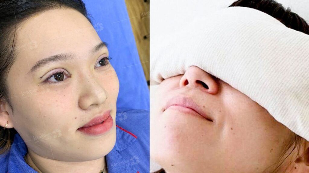 Chăm sóc sau cắt mí như thế nào để mí mau lành và vào form đẹp?