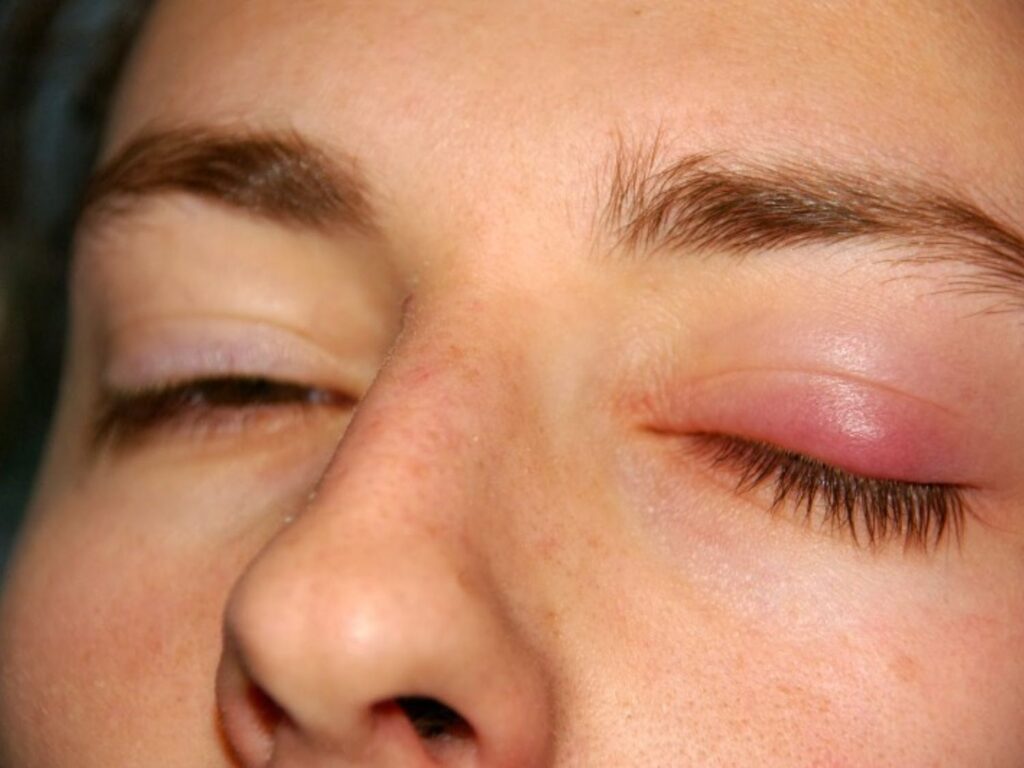 Mí mắt sưng không giảm