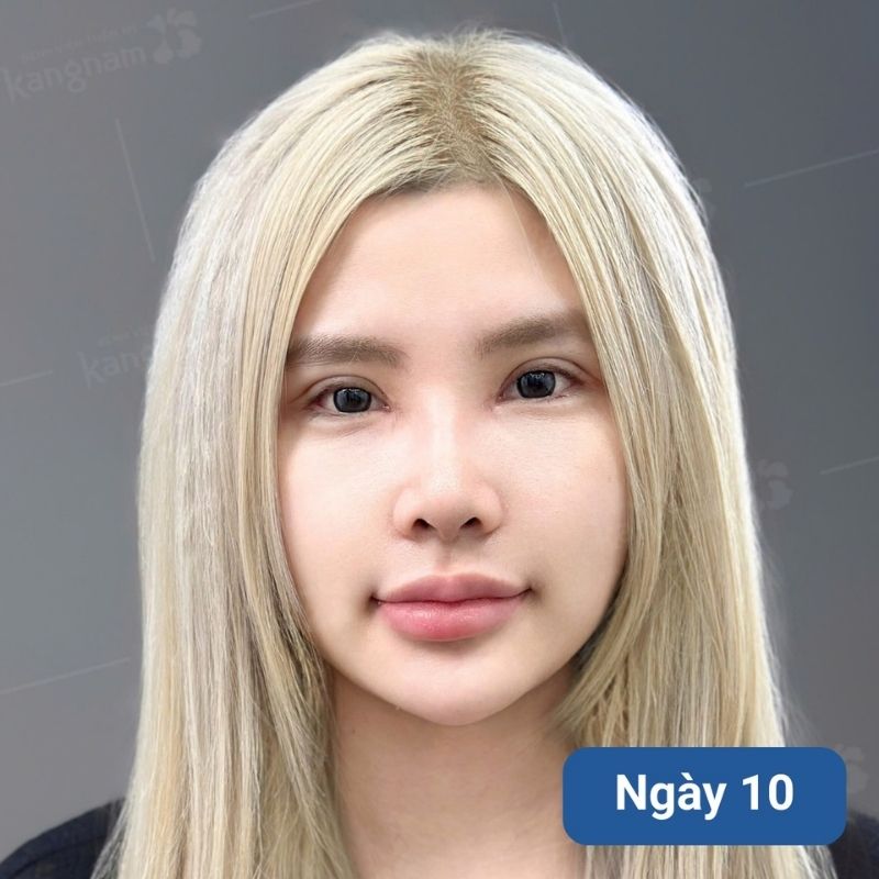 Mũi được 10 ngày đã ổn định nhưng vẫn cần chú ý chăm sóc kỹ