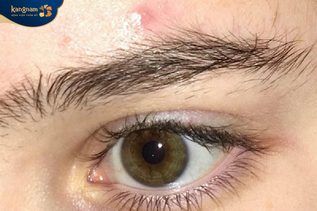 Lông mày mọc ngược thiếu đồng nhất