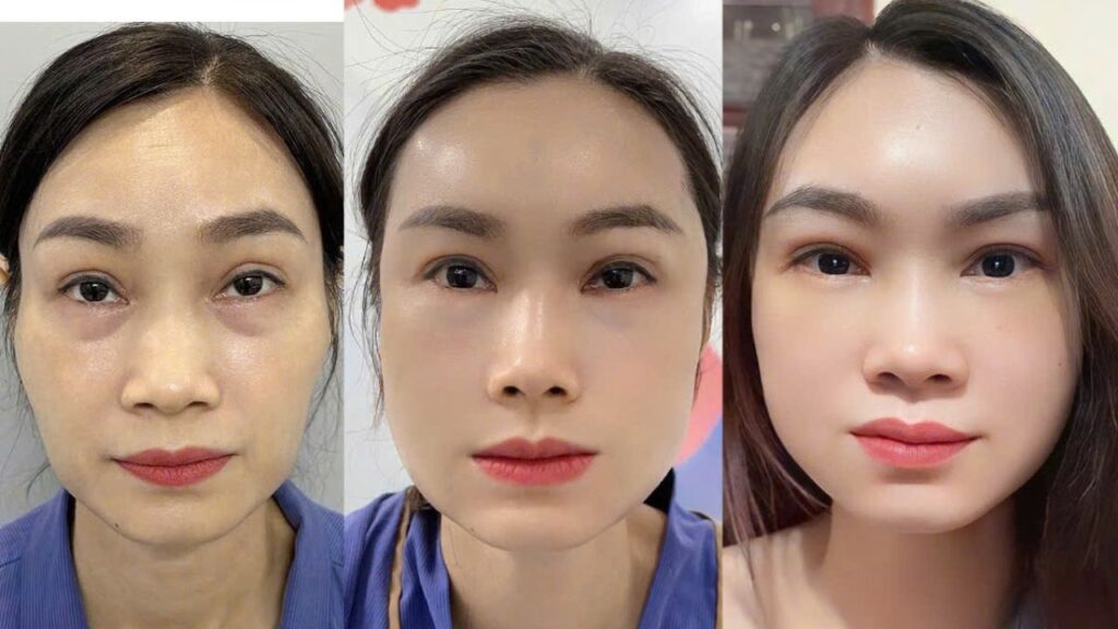 Chi phí cấy mỡ tự thân bao nhiêu tiền hiện nay?