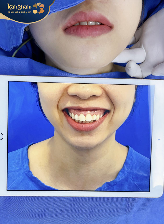 Xương hàm trên phát triển quá đà khiến cả vùng hàm bị đẩy ra ngoài