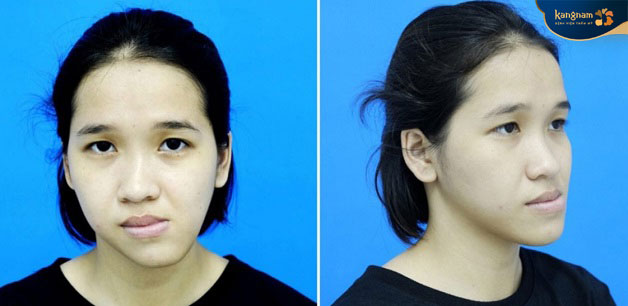 Gương mặt bị lệch hàm sang một bên