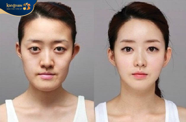 Nguyên nhân lệch hàm chủ yếu do bẩm sinh