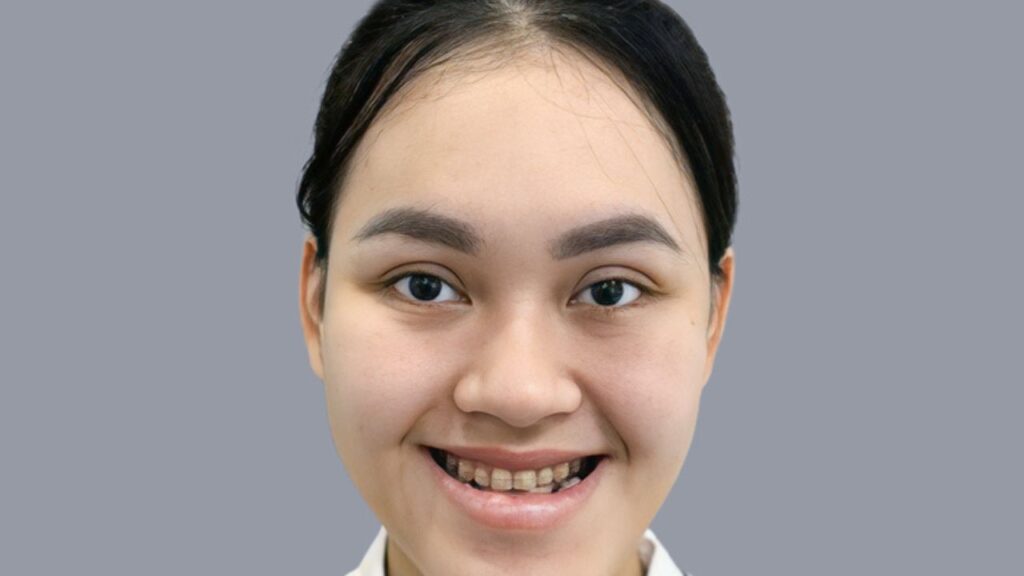 Chỉnh khớp cắn là gì? Giải mã 5 dạng sai khớp cắn và lộ trình điều trị chuẩn y khoa