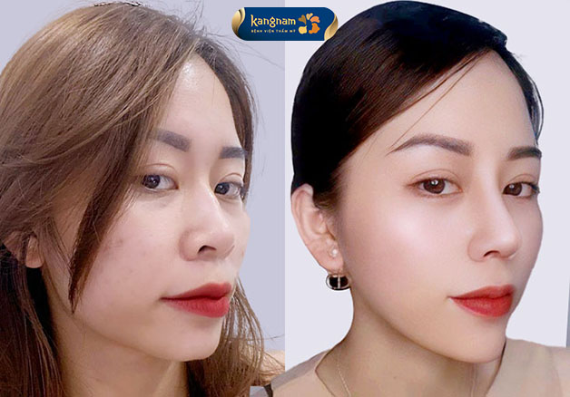 Khuôn mặt đạt tỷ lệ vàng sau khi sửa mũi hếch