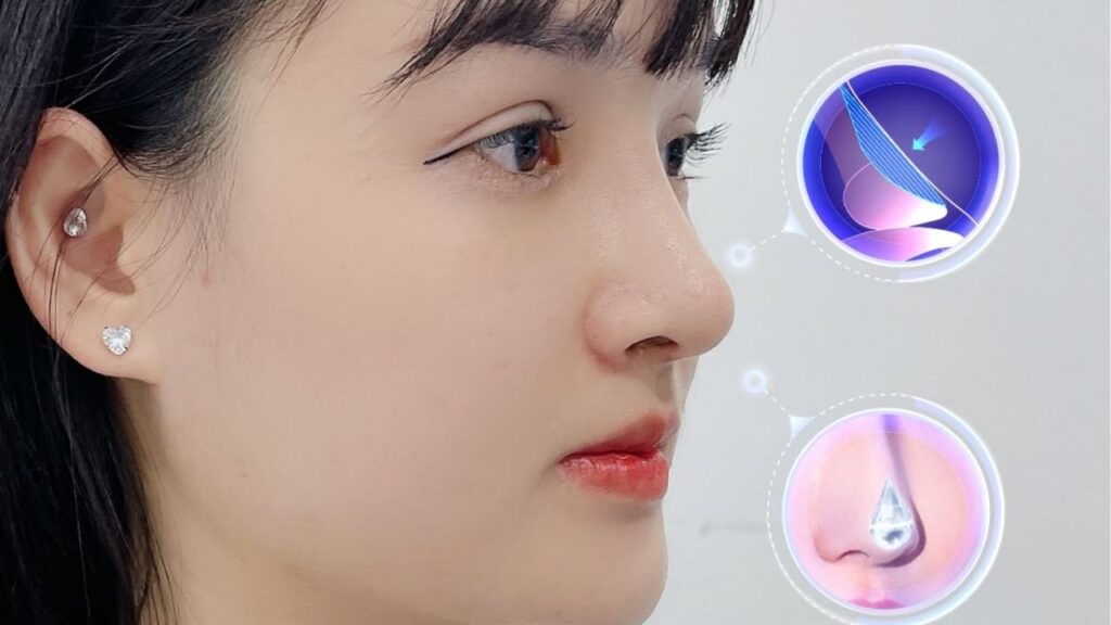 Giải mã sức hút của Nâng mũi Idol: Công nghệ nâng mũi tiên tiến bậc nhất hiện nay