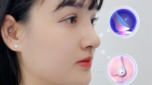 Giải mã sức hút của Nâng mũi Idol: Công nghệ nâng mũi tiên tiến bậc nhất hiện nay