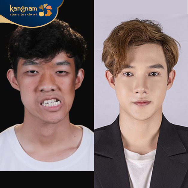 Minh Hoàng lột xác sau khi chỉnh hàm lệch tại Kangnam