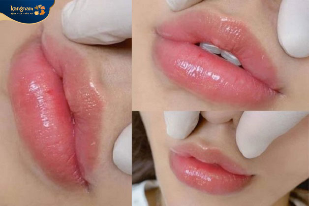 Điển hình một dáng môi tiêm filler đẹp