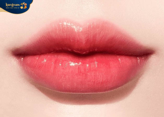 Tiêm filler dáng môi tim trẻ trung