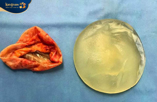 Tình trạng co thắt bao xơ sau đặt túi ngực