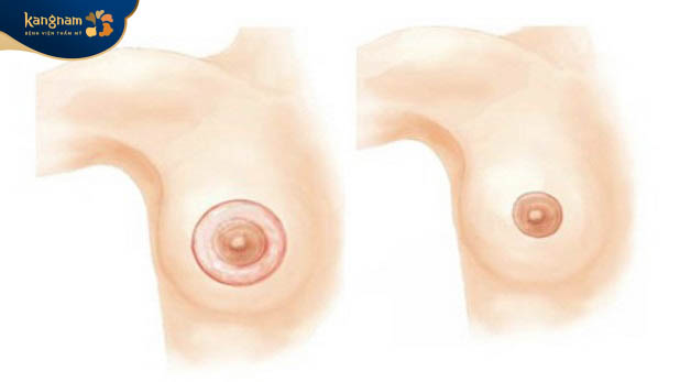 Thu nhỏ quầng vú để núm vú nhỏ gọn, cân đối