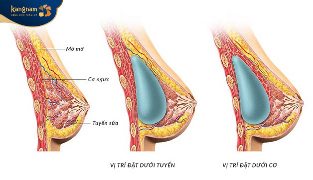 Đặt túi ngực dưới cơ ngực giảm thiểu tình đặt co thắt bao xơ
