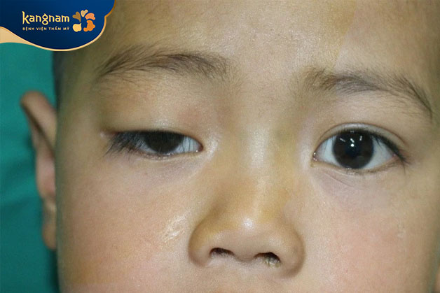 Khó tập trung nhìn vào một vật thể trong thời gian dài