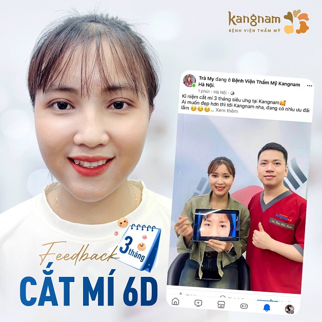 Nhận được nhiều phản hồi tích cực của khách hàng sau 3 tháng cắt mí 6D