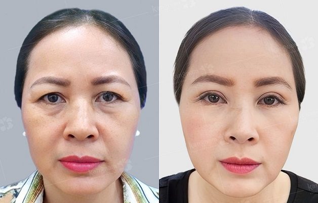 Khách hàng sở hữu đôi mắt tươi trẻ sau khi lấy mỡ bọng mắt nội soi