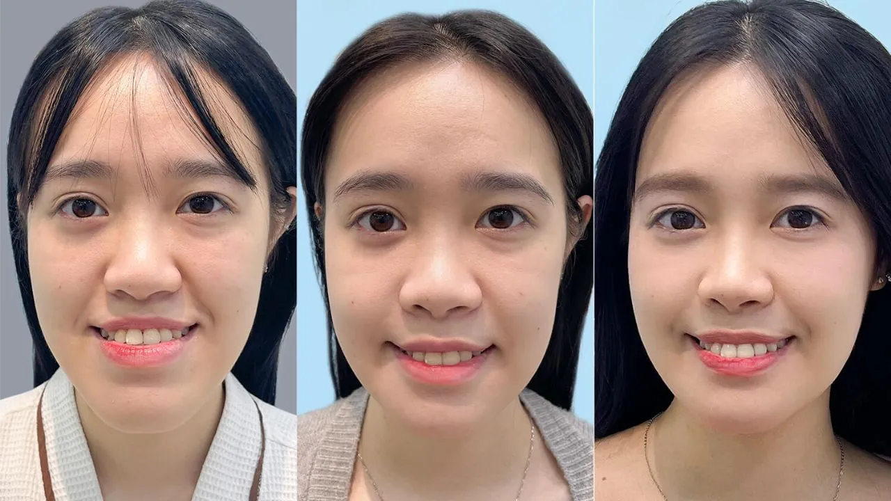Khách hàng Thùy Linh gặp tình trạng hàm móm, khớp cắn ngược trước và sau phẫu thuật