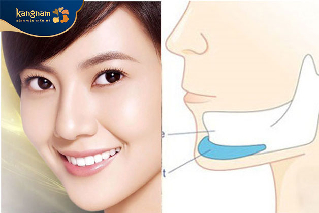 Độn cằm sụn nhân tạo