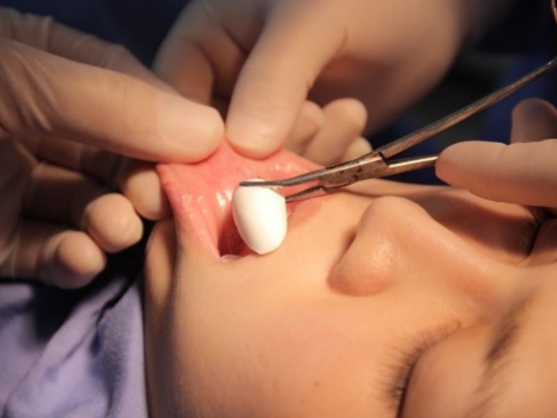 Sau khi độn cằm vết thương sẽ hơi đau nhức