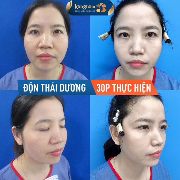Quá trình thực hiện độn thái dương nhẹ nhàng, nhanh chóng