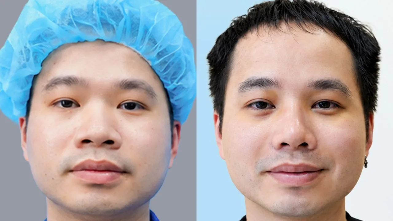 Anh Evan Lê (Việt kiều Mỹ) trước và sau khi nâng mũi