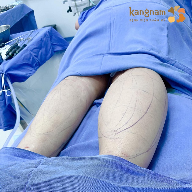 Công nghệ Lipo 360 an toàn với khách hàng