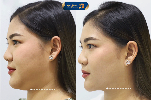 Khách hàng có hai cằm xuất hiện rõ sau sinh, giảm mỡ nọng cằm thành công tại Kangnam, sở hữu gương mặt thon gọn