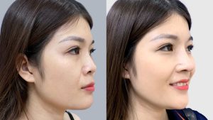 Chiêm ngưỡng kết quả nâng mũi cấu trúc Idol sau 1 tháng