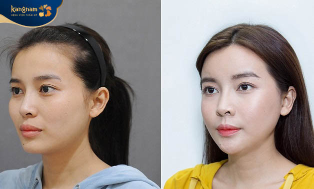 Bác sĩ tạo một đường mổ mảnh ở bên trong khoang miệng nên không để lại sẹo