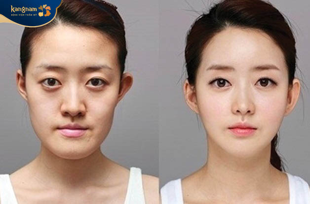 Phương pháp phẫu thuật chỉnh cằm vline