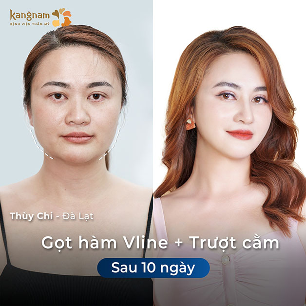 Thùy Chi trở nên xinh đẹp sau khi gọt hàm
