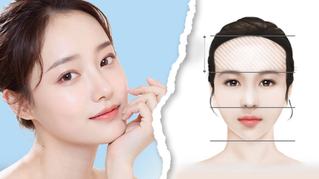Gọt trán an toàn, nhanh chóng – Hạ trán tới 2cm, hết trán dô, tự tin ngoại hình mới