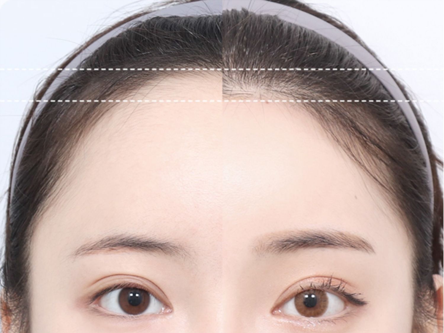 Trán cân đối với khuôn mặt