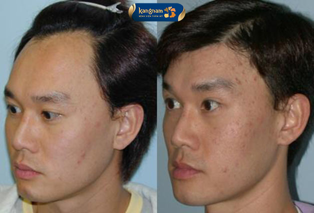 Khách hàng trẻ ra sau khi hạ đường chân tóc